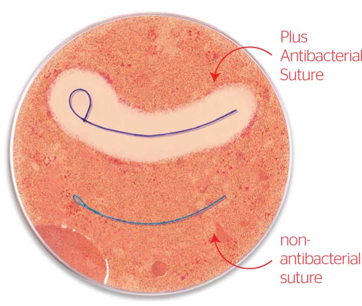Plus antibacterial sutures have been shown in vitro to inhibit bacterial colonization of the suture for seven days or more, for protection against the most common organisms associated with surgical site infections. Photo courtesy of Ethicon